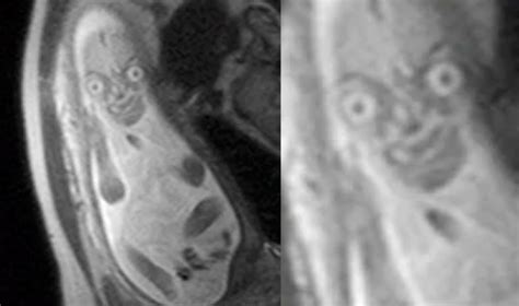 Bizarre Mri Scan Of Unborn Baby Looks Like Pickle Rick Or Mr Bean