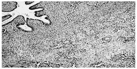 Endometrial Polyp With Sex Cord Like Pattern International Journal Of Gynecological Pathology