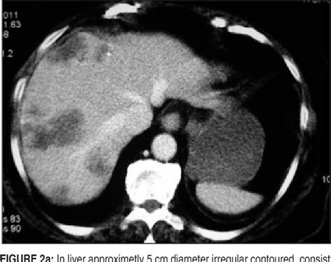 Figure 1 From Primary Malignant Hepatic Epithelioid