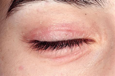 Eczema Around The Eye Photograph By Dr P Marazzi Science Photo Library