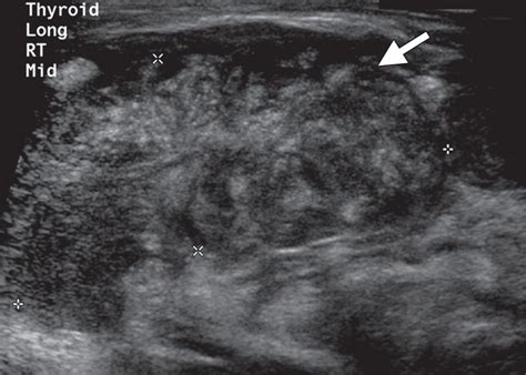 The Thyroid Review Of Imaging Features And Biopsy Techniques With Radiologic Pathologic