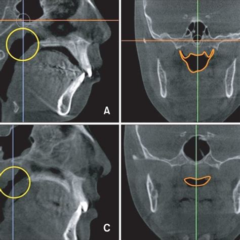 Examples Of The 2 Types Of Nasopharyngeal Airway Shapes Preadolescents