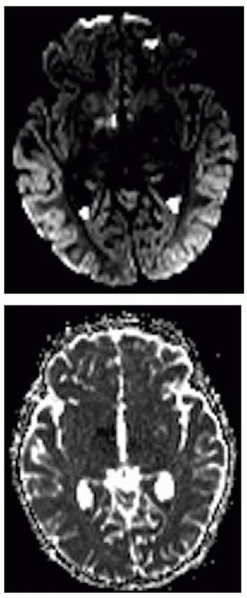 Intracranial Infection And Inflammation Radiology Key