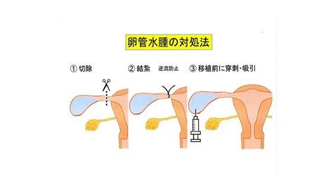 卵管水腫の治療～卵管切除～ よくあるご質問徐クリニック