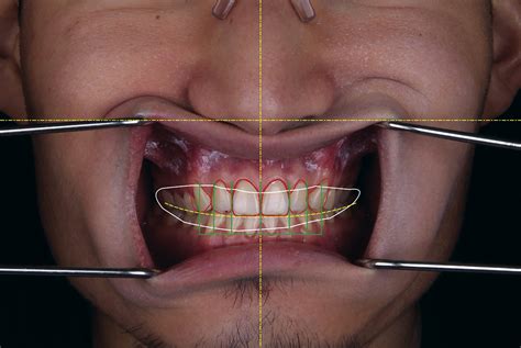 Comprehensive Digital Approach With The Digital Smile System A Clinical Report Journal Of