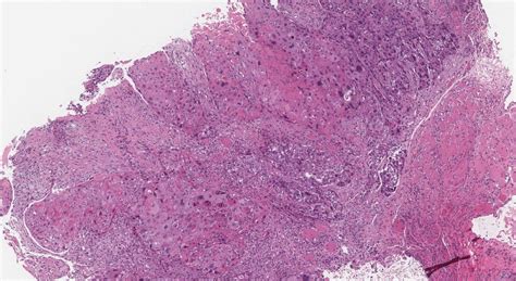 HPV-associated squamous cell carcinoma of the oropharynx | Ottawa Atlas ...