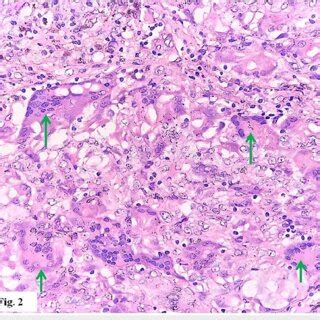 Histiocytic multinucleated giant cells (green arrows) (hematoxylin &... | Download Scientific ...