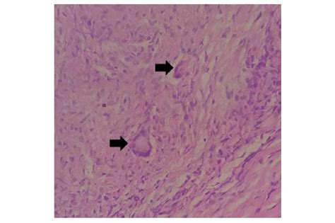 Histology revealing presence of multiple non-caseating granulomas ...