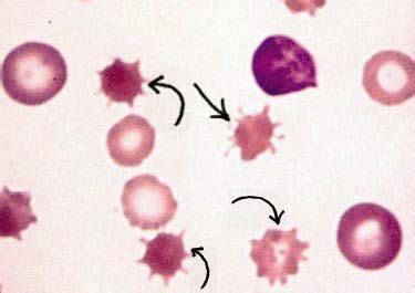 Rbc Abnormalities Flashcards Quizlet