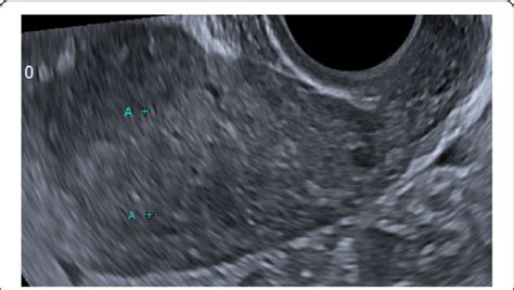 Sagittal View By Tvus Showing A Thickened Endometrium Measuring About