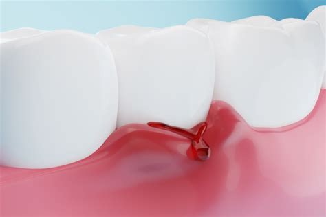 Why Are My Gums Bleeding American Dental