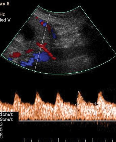 How Useful Is Uterine Artery Doppler Ultrasonography In Predicting Pre