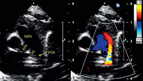 Patent Ductus Arteriosus And Aortopulmonary Window Thoracic Key