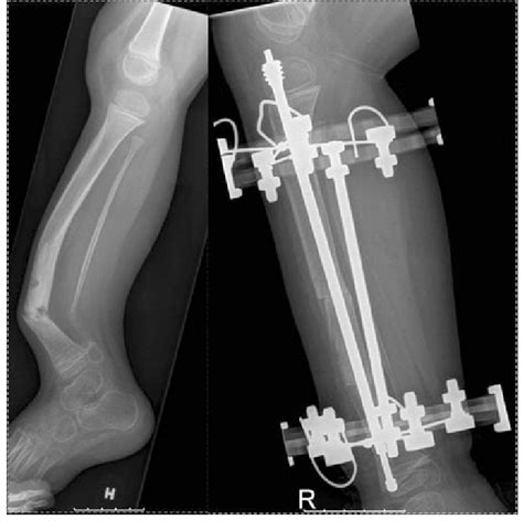 Femur Intramedullary Nailing Cpt Nail Ftempo