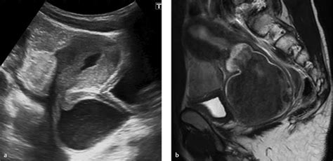 15 Sonography Of The Female Genital Tract Radiology Key