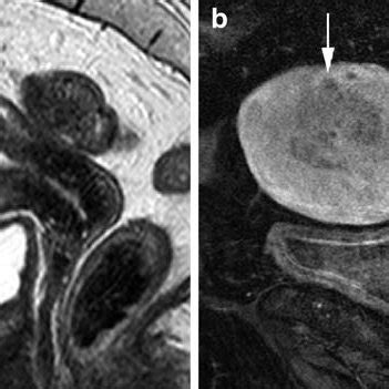 (PDF) Staging of endometrial cancer with MRI: Guidelines of the ...