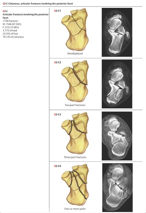 Foot Fractures Musculoskeletal Key