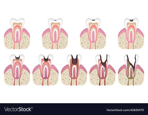 Stages Of Caries Development Tooth Structure Vector Image