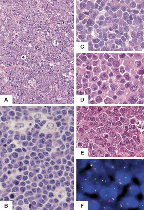 Morphology Of Burkitt Lymphoma And Dlbcl A A Low Power Overview At