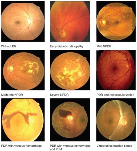 Fundus images of normal (background retinopathy), mild NPDR, moderate ...