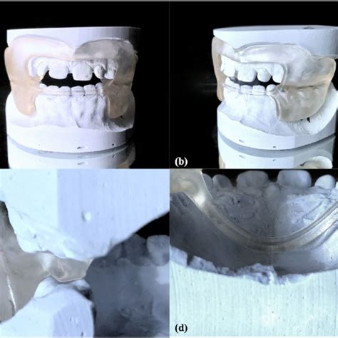 CAD CAM Functional Regulator 3 CAD FR3 On Plaster Model A B To