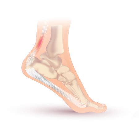 Calf Pain And Achilles Pain Marlow Sports Therapy