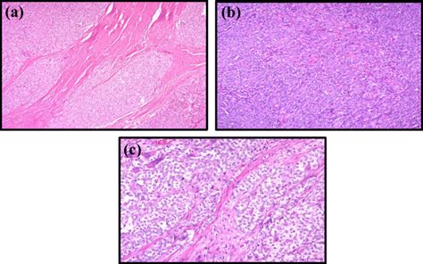 A Diffusely Infiltrating Neoplasm In The Wall Seen In Vague Lobules