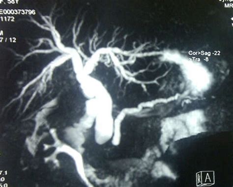 MRCP showing dilated common bile duct, intrahepatic duct and the ...