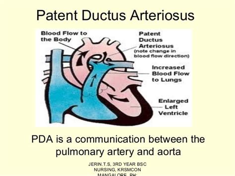 Ductus Arteriosus Diagram