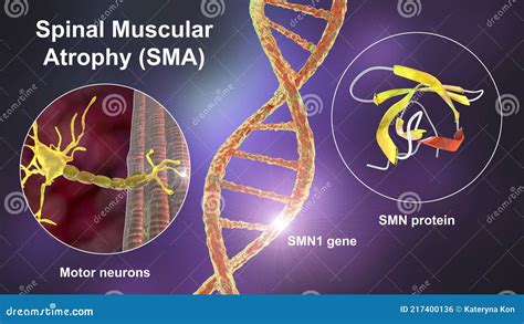 Spinal Muscular Atrophy Sma A Genetic Neuromuscular Disorder Stock