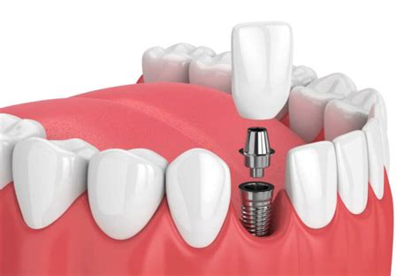 Precio De Los Implantes Dentales En Gij N Clinica Dental Palomero