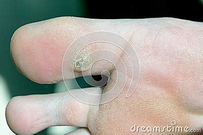 Plantar Wart On Big Toe Visible Black Dots Warts Royalty Free Stock