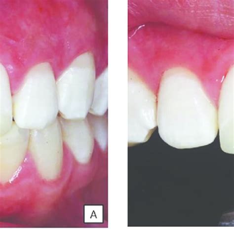 A Observe The Conservative Removal Of Enamel With Mih B Lateral