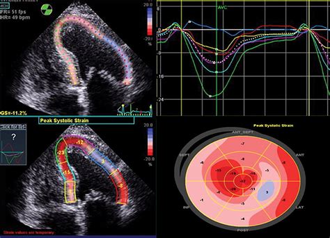 Myocardial Strain Evaluation With Cardiovascular Mri Physics