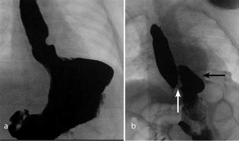 Hiatal Hernias A Sliding Hiatal Hernia Gastroesophageal Junction Is