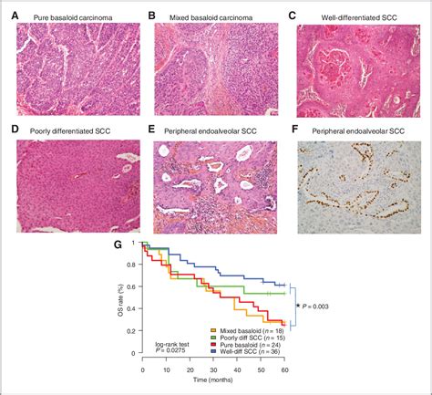 Figure 1 From Lung Squamous Cell Carcinomas With Basaloid Histology