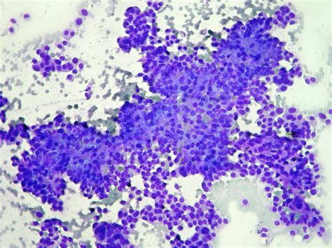 Breast Cytopathology Cellnetpathology