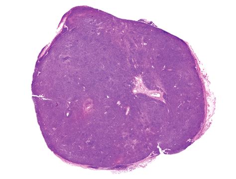 The Spectrum Of Vascularized Superficial Soft Tissue Tumors On Sonography With A Histopathologic