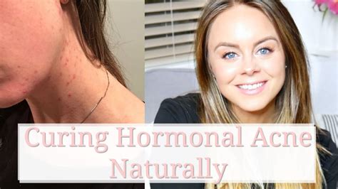 Hormonal Acne Coming Off The Pill Curing Hormonal Acne Without