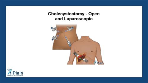 Cholecystectomy Open And Laparoscopic Youtube