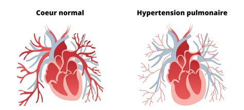 Hypertension Pulmonaire C Ur Poumons