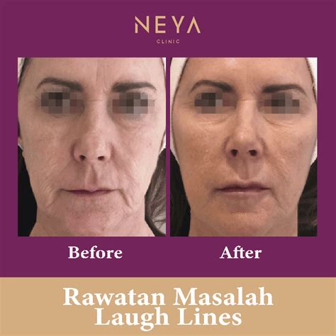 Professional Profhilo Treatment In Malaysia Neya Clinic