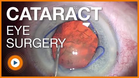 Ophthalmic Surgical Microscope Cataract Surgery Youtube