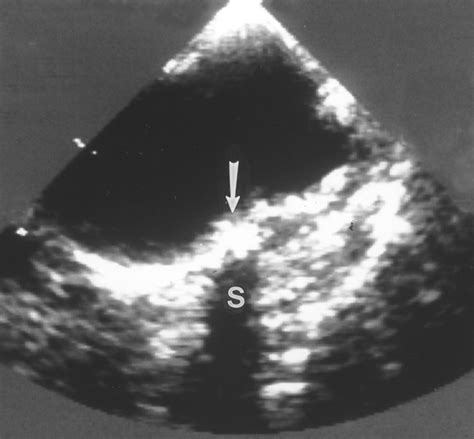 Diagnostic Imaging Of Thoracic Aortic Atherosclerosis Ajr