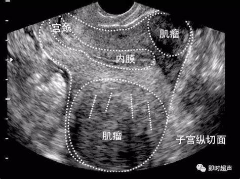 子宫肌瘤超声分类诊断粘膜下肌瘤浆膜下肌瘤子宫肌瘤超声诊断回声 健康界