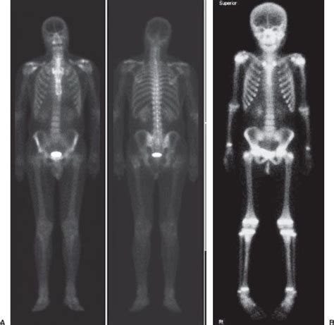 Normal Bone Scan
