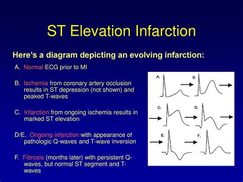 T Wave Elevation