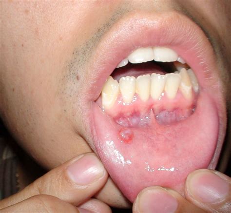 Mucous Cyst Lip