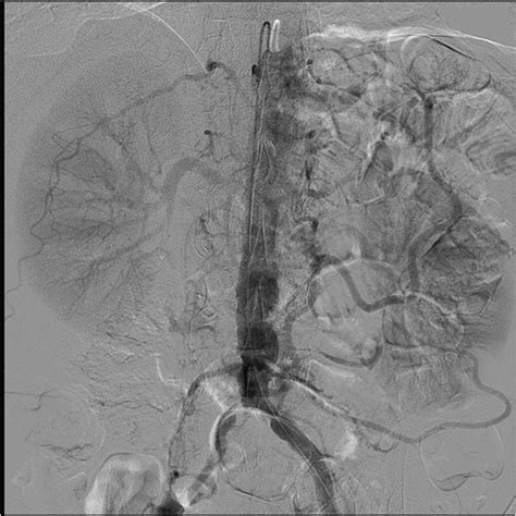 Mesenteric angiogram: both the celiac and superior mesenteric arteries ...