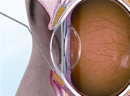 Meibomian Gland Probing For Patients Mgdinnovations